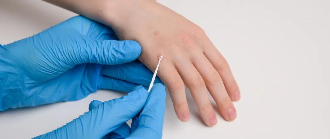 doctor in blue gloves examines child hand